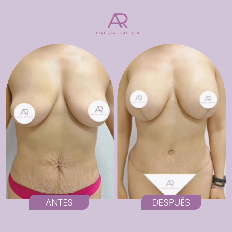 antesydespues-MOMMY01