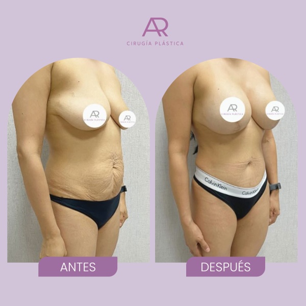 antesydespuesMOMMY02