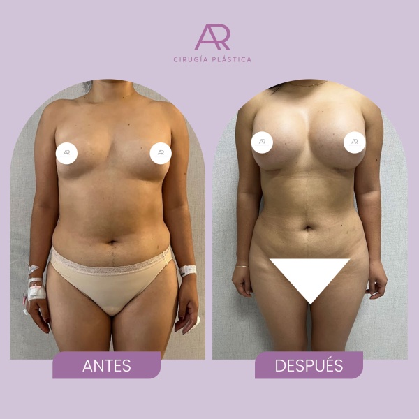 antesydespuesMOMMY03